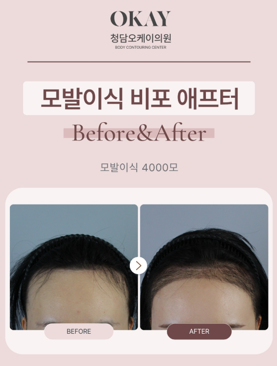 M자모발이식, 심은 머리가 다시 빠질 수도 있을까? 관련 이미지 4