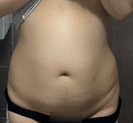 If you’re 고민ing about belly fat liposuction, which method is right for you in terms of price, side effects, and recovery period? image 7