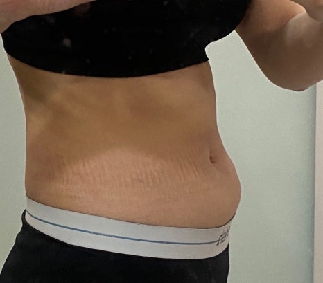 If you’re 고민ing about belly fat liposuction, which method is right for you in terms of price, side effects, and recovery period? image 5