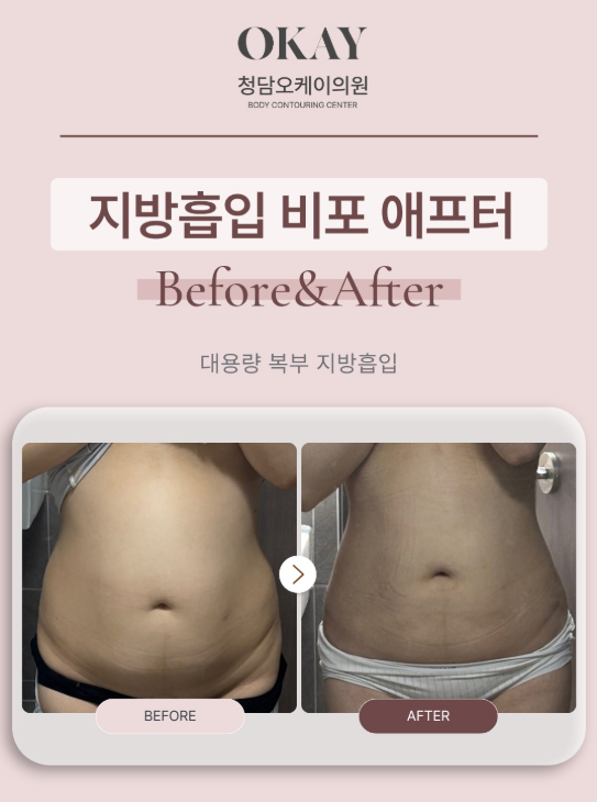 강남성형외과 복부 지방흡입, 슬림한 허리라인은 이렇게 완성됩니다 관련 이미지 8