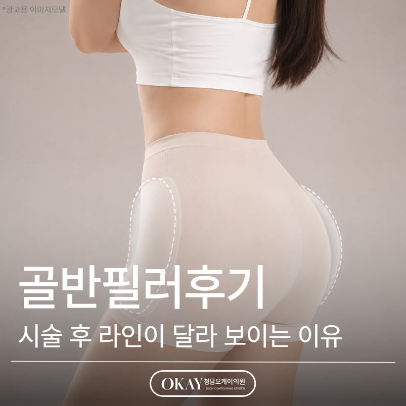 골반필러후기, 시술 후 라인이 달라 보이는 이유 설명드립니다 관련 이미지 1