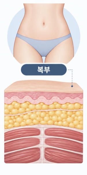 지방흡입수술방법, 허벅지와 복부가 다른 이유는? 관련 이미지 4