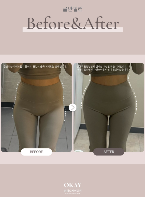 연예인골반필러,타고난 듯 예쁜 골반라인의 비밀은? 관련 이미지 9