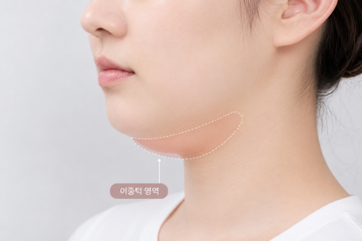 How Long Is the Recovery Period After Facial Liposuction? A Guide to Returning to Work, Washing Your Face, and Exercising image 5