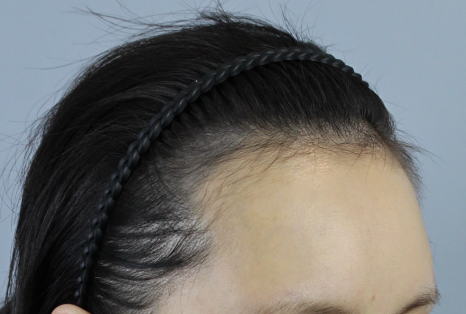 Hair Transplant Take-In Period: When Will the Grafts Fully Settle? A Complete Overview of Changes by Stage image 6
