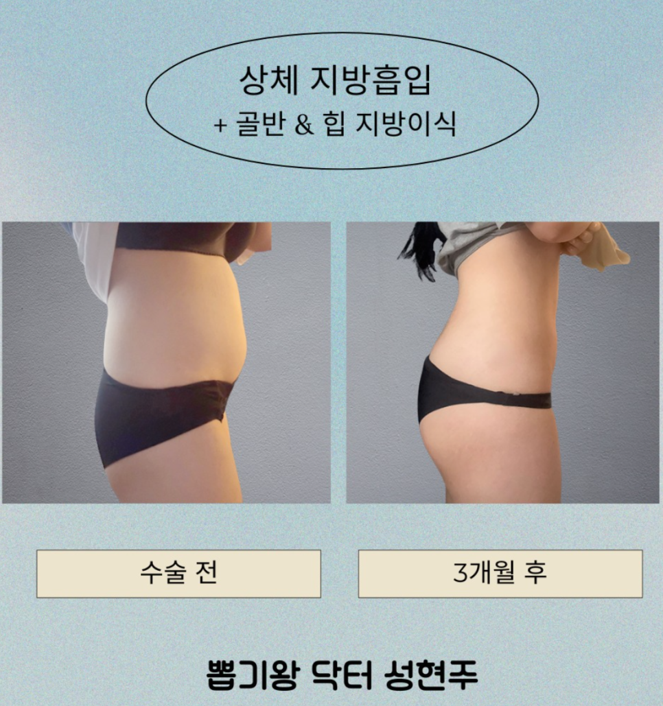 복부지방흡입 후기, 실제 허리라인은 어떻게 달라질까요? 관련 이미지 8