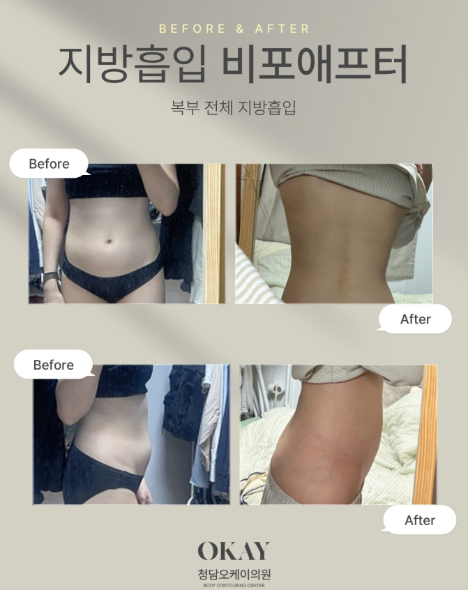 압구정 다이어트, 지방흡입 후기로 보는 부위별 라인 변화 관련 이미지 5