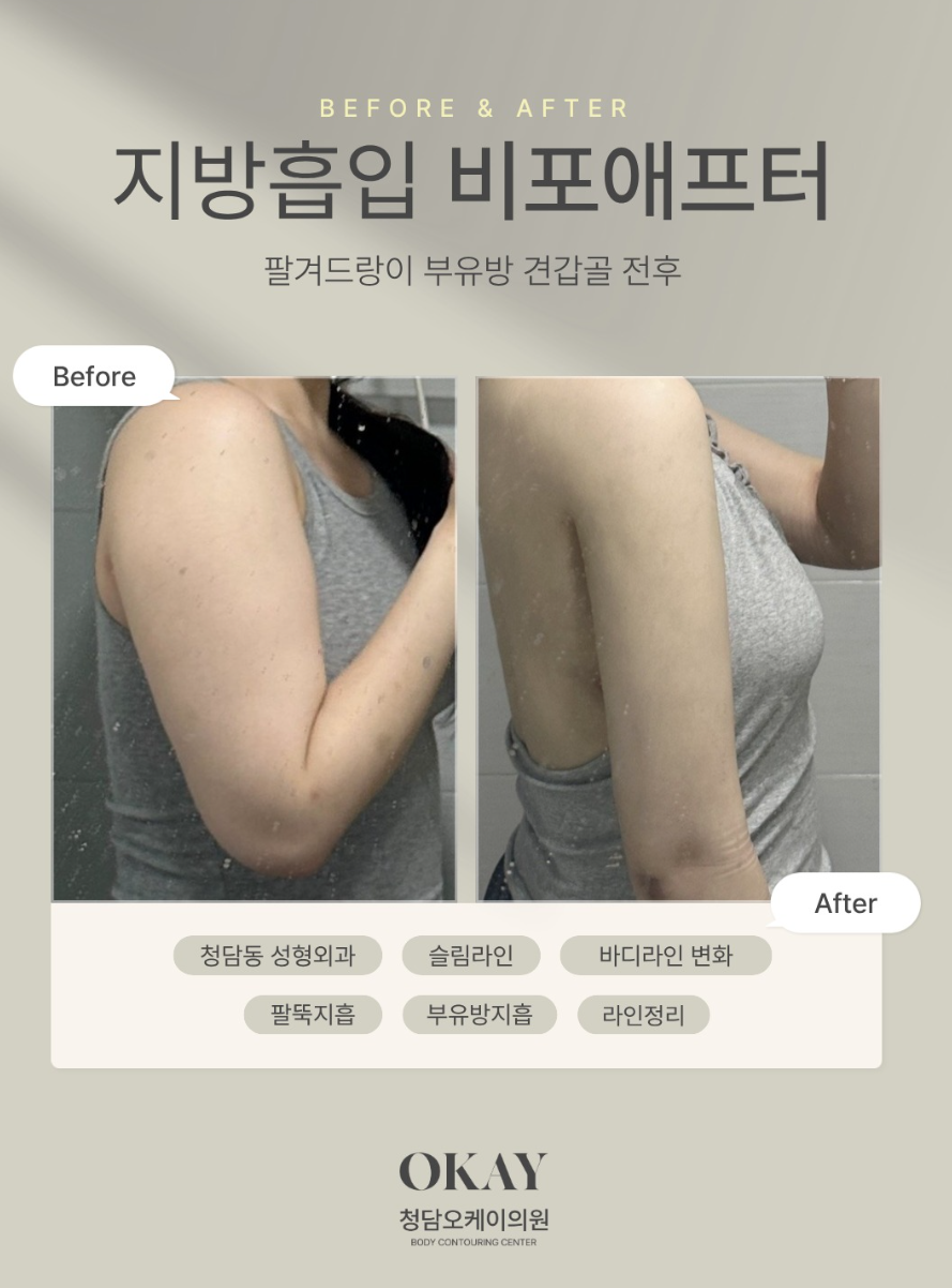 팔뚝지방흡입수술비용, 팔뚝 굵기에 따라 달라질 수 있을까요? 관련 이미지 7