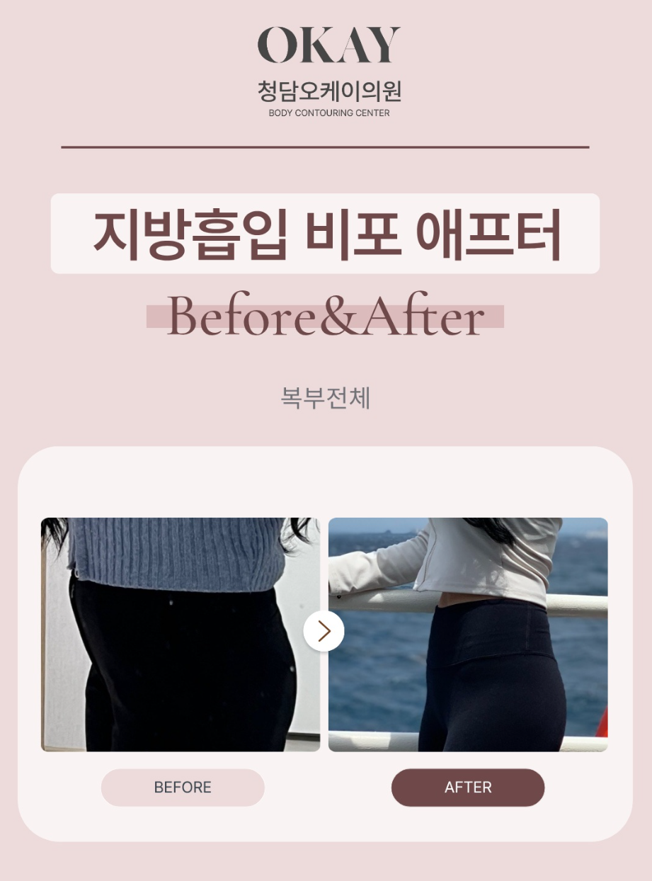 뱃살지흡 후기, 아랫배부터 옆구리까지 어디까지 달라질까요? 관련 이미지 8