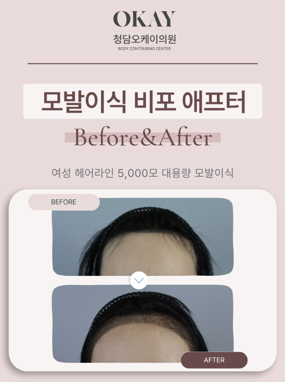 서울앞머리모발이식, 얼굴이 작아 보이는 헤어라인의 비밀 관련 이미지 10