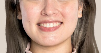 Side Effects of Cheek Fat Grafting: Whether Removal Is Possible, Plus Causes of Sagging and Calcification image 2