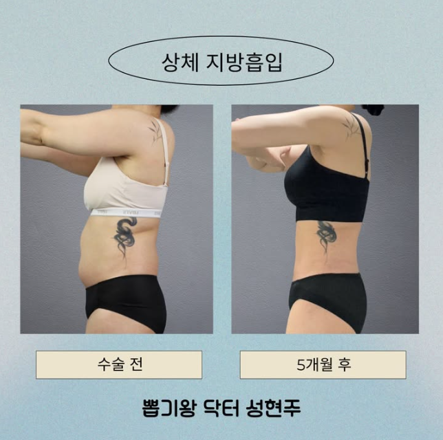 신사동성형외과 복부지방흡입 수술 후 복부 라인 어떻게 달라질까 관련 이미지 10