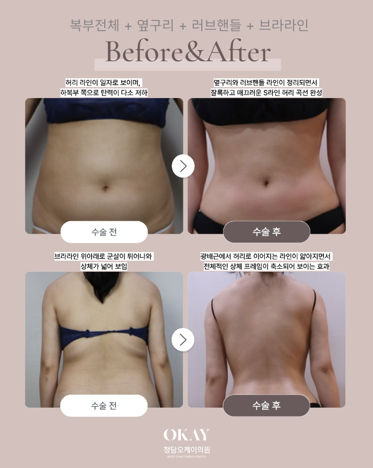 Will You Get Uneven Lumps If You Don’t Do Post-Liposuction Care? A Frequently Asked Question image 5