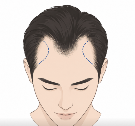 M자헤어라인모발이식, 몇 모나 심어야 자연스러울까? 관련 이미지 2