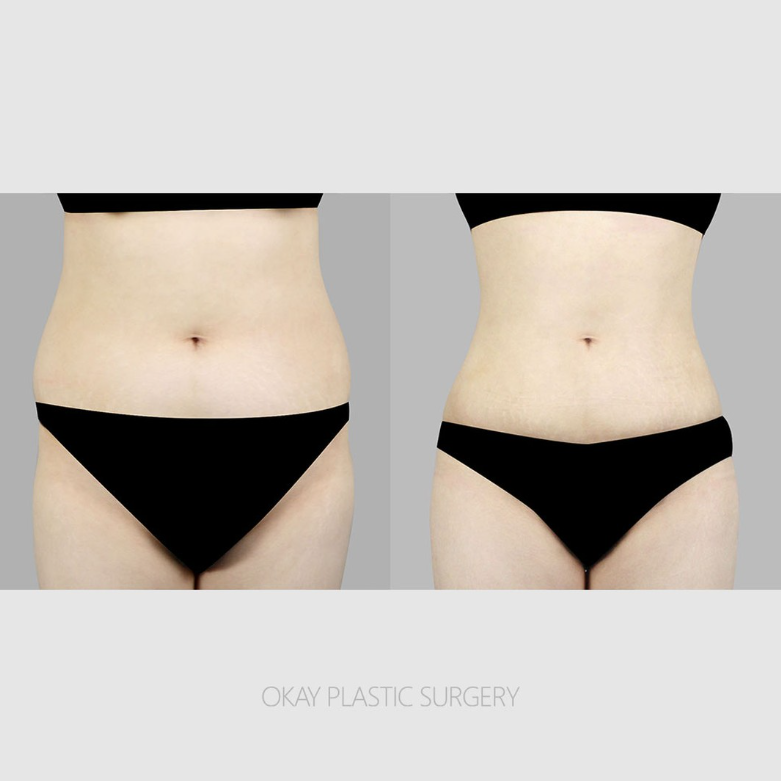 Liposuction Side Effects: What Determines Satisfaction Is Not the Amount Removed image 6