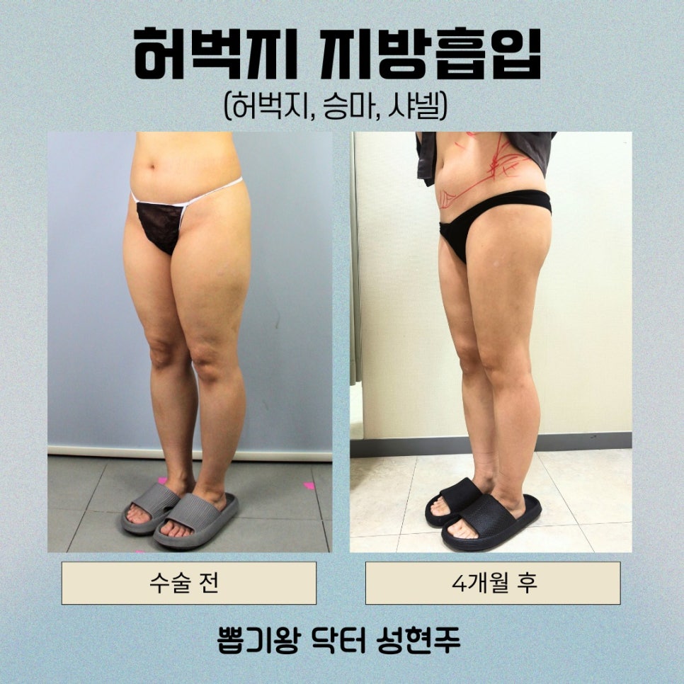 Why Satisfaction Differs After Thigh Liposuction: What You Miss When You Focus Only on the Inner Thighs image 4