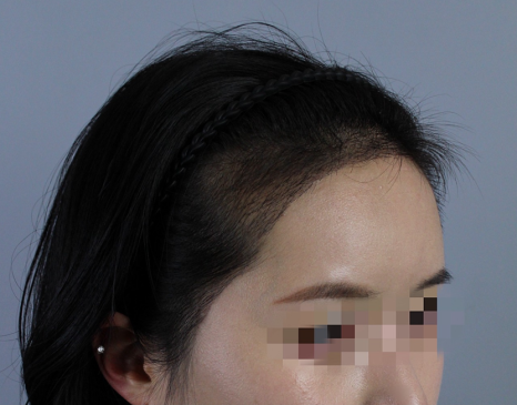 Female Crown Hair Transplantation: Explaining Why Results and Graft Survival Rates Differ image 6