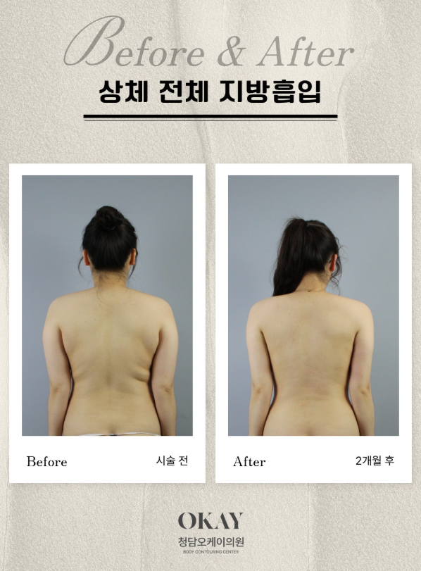 지방흡입가격, 지방을 많이 뺄수록 비용도 올라갈까요? 관련 이미지 7
