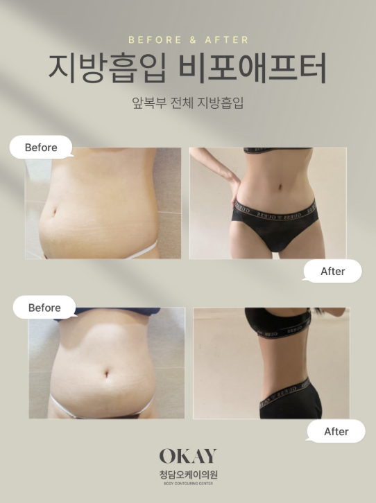 강남성형외과 복부 지방흡입, 슬림한 허리라인은 이렇게 완성됩니다 관련 이미지 10