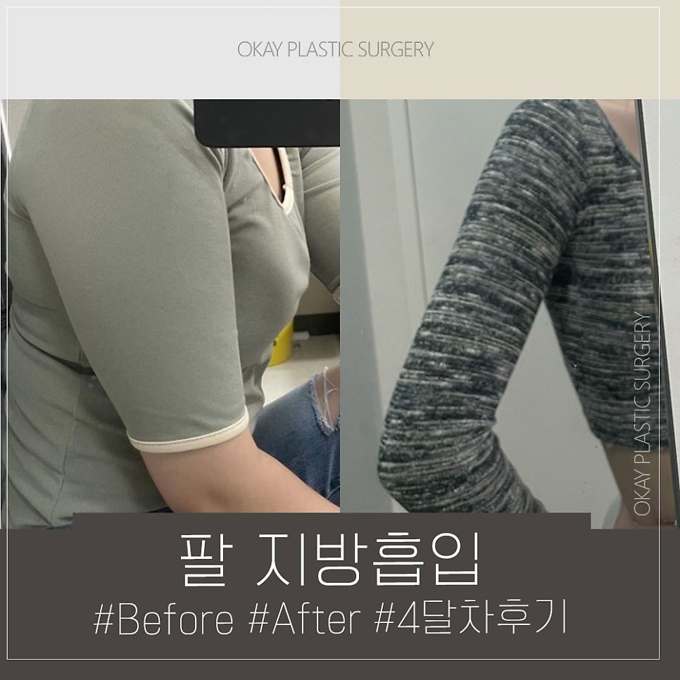Liposuction Surgery Method: The Truth and Misconceptions About Pain, Bruising, and Side Effects, Directly Explained by the Director image 4