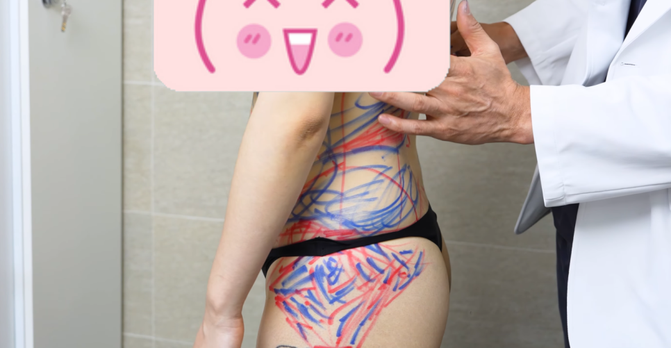 압구정 엉덩이지방이식, 흉터·압박복·유지기간까지 현실적으로 알려드립니다 관련 이미지 4