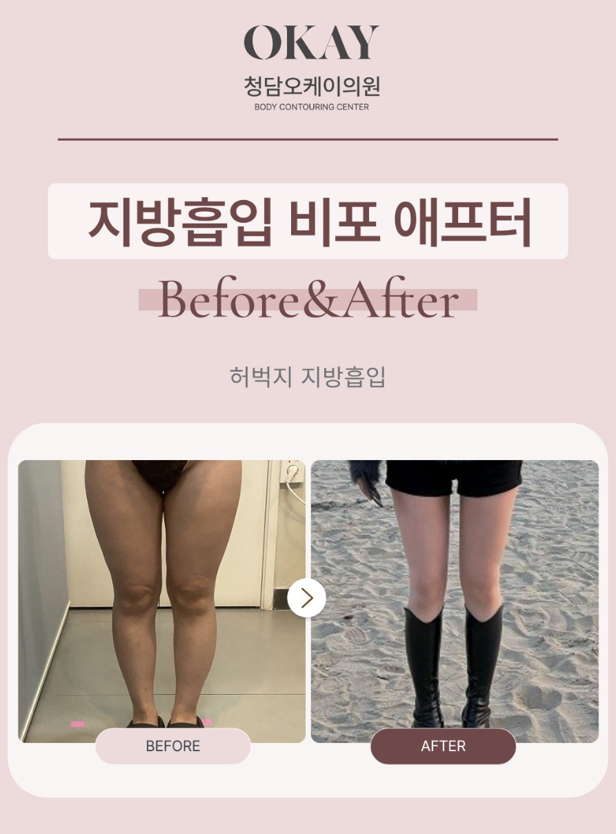 전신지방흡입, 한 번에 여러 부위 진행해도 괜찮을까요? 관련 이미지 7