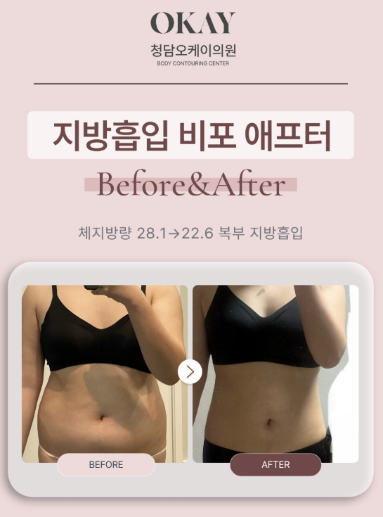 강남전신지방흡입, 팔·복부·허벅지 한 번에 고민한다면 관련 이미지 7