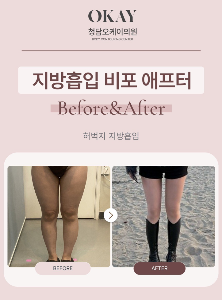 허벅지안쪽지방흡입, 라인이 예뻐지는 시기는 언제부터일까요? 관련 이미지 5
