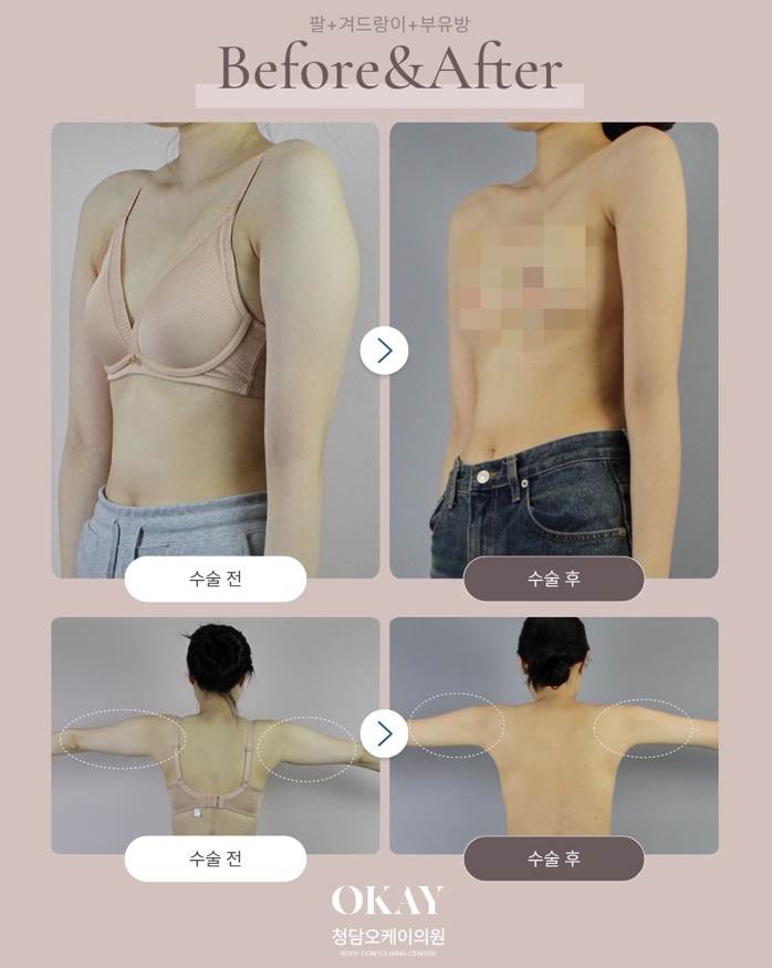 Arm Liposuction Review: A Clear Overview of the Recovery Process and Changes in Contour image 4