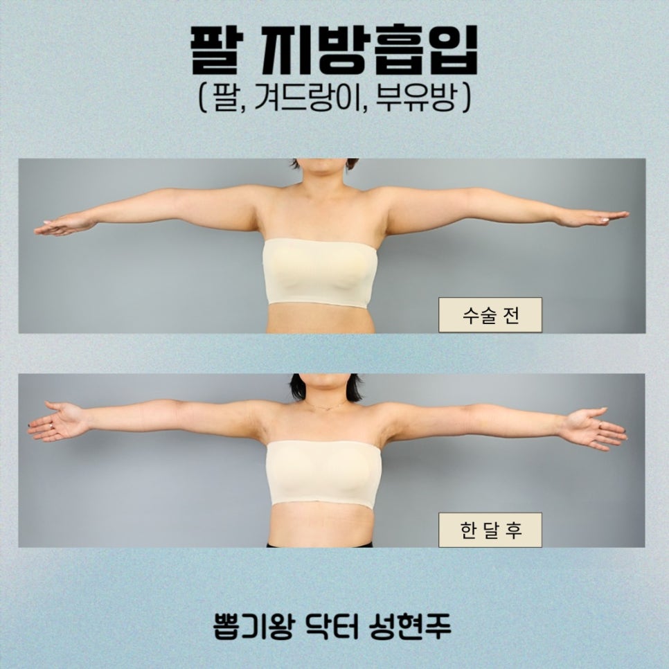 팔뚝지방흡입후관리, 결과를 오래 유지하려면 이것부터 확인하세요 관련 이미지 2
