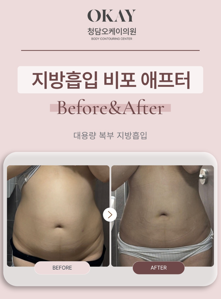 전신지방흡입, 한 번에 여러 부위 진행해도 괜찮을까요? 관련 이미지 6