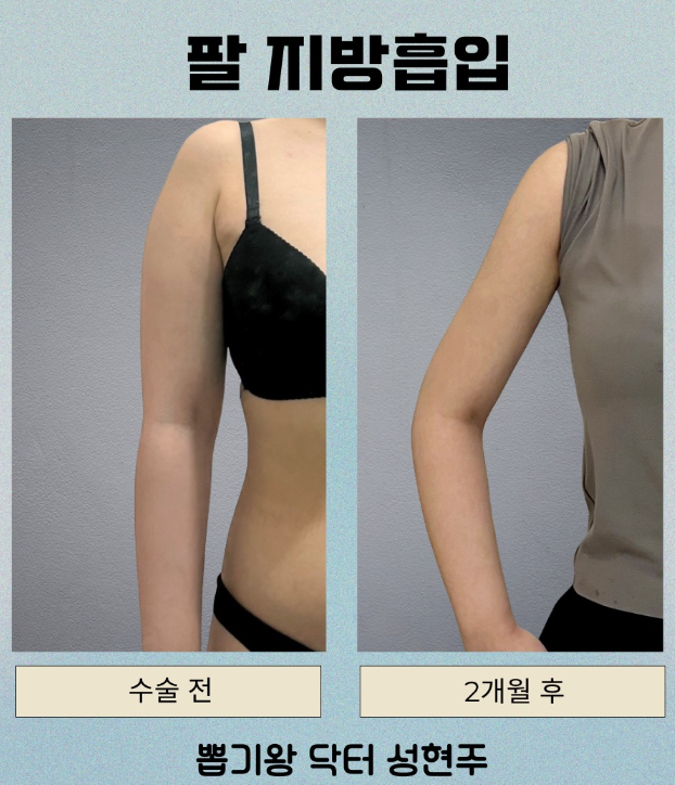 부유방빼기, 팔을 내렸을 때 더 튀어나와 보이는 이유는? 관련 이미지 8