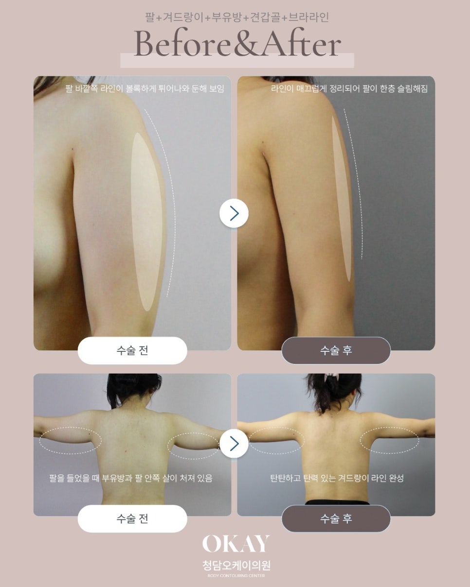 팔지방흡입, 내돈내산 후기보다 먼저 확인해야 하는 처짐·멍·회복기간 관련 이미지 2