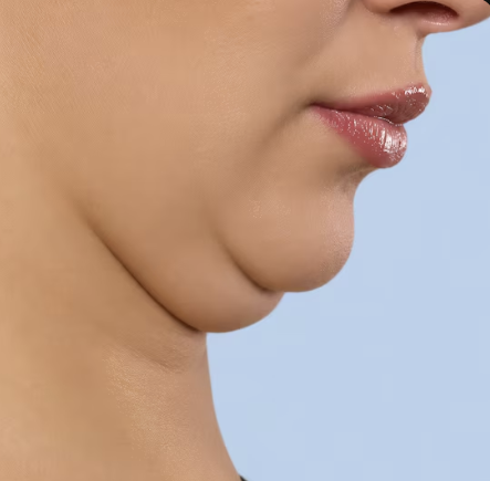 압구정로데오 성형외과, 이중턱 지방흡입만으로 충분할까? 관련 이미지 4
