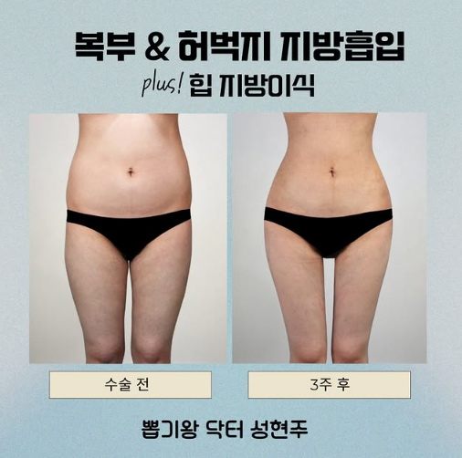 Cheongdam-dong Plastic Surgery Clinic: This Is More Important Than the Amount Removed in Thigh Liposuction image 10
