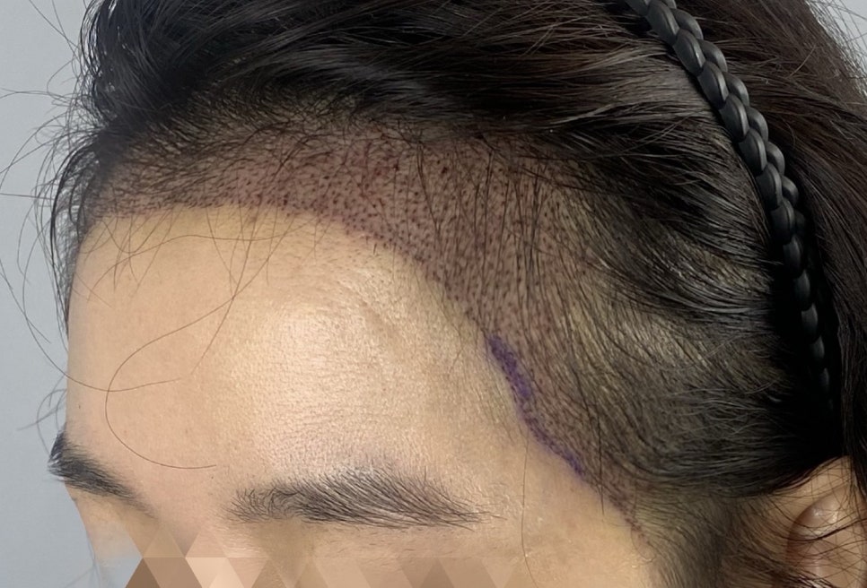 강남 여자앞머리모발이식 생착률 얼마나 될까? 몇모·디자인·통증·가격 정리 관련 이미지 9