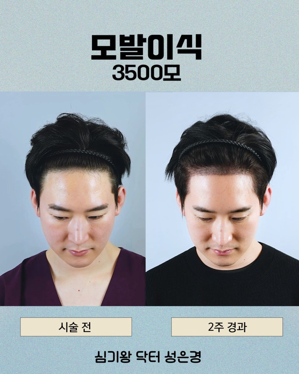 모발이식 3000모, 많을수록 좋은 걸까요? 관련 이미지 6