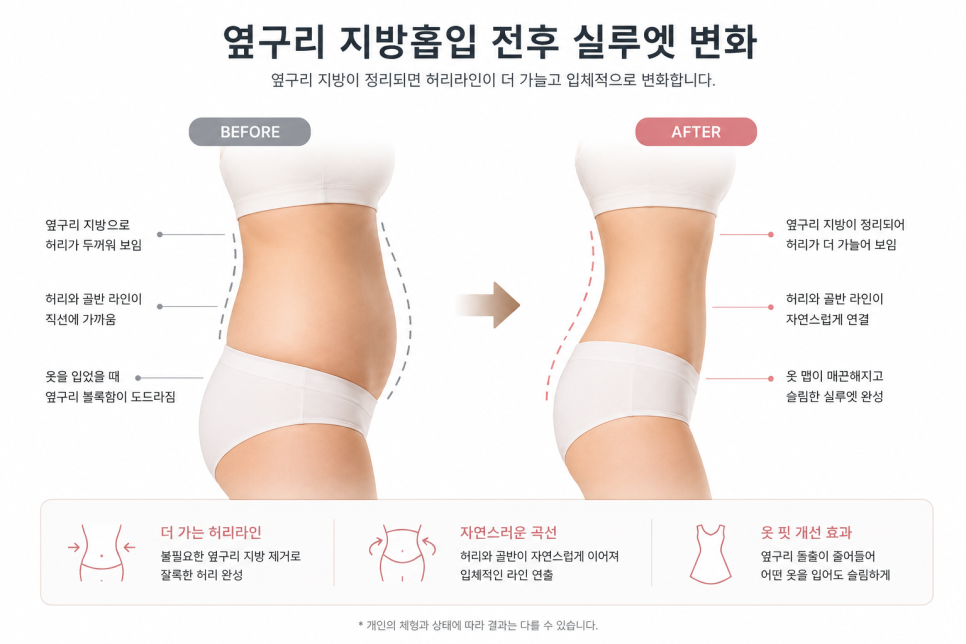 옆구리지방흡입, 허리라인 디자인이 중요한 이유 관련 이미지 5
