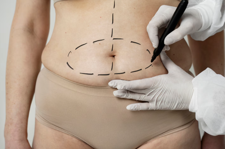 복부지방흡입가격, 뱃살이 많을수록 비용도 올라갈까요? 관련 이미지 8