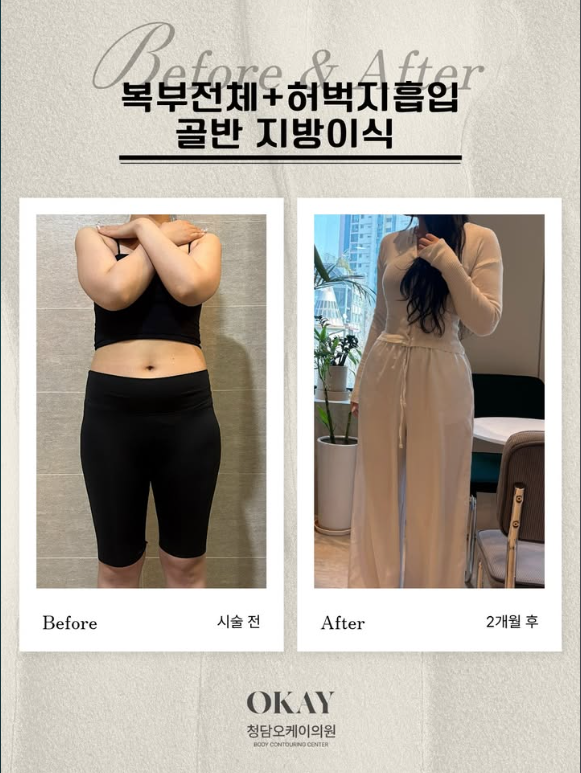 복부지방흡입부작용, 흉터보다 더 신경써야 할 문제 울퉁불퉁함&middot;처짐&middot;유착이 생기는 이유 관련 이미지 5