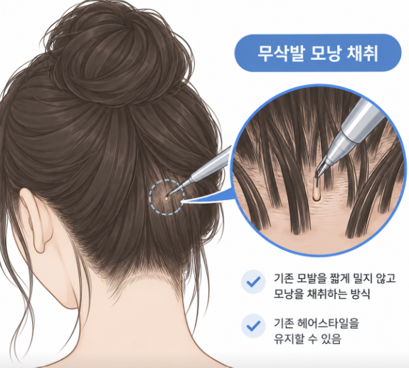 비절개모발이식 박스컷, 수술 후 티가 많이 날까? 관련 이미지 8