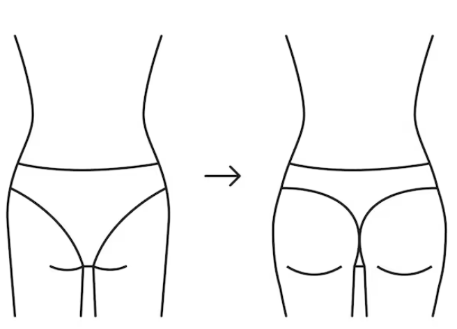 골반지방이식 vs 골반필러, 내 체형에 맞는 선택 기준 총정리 관련 이미지 2