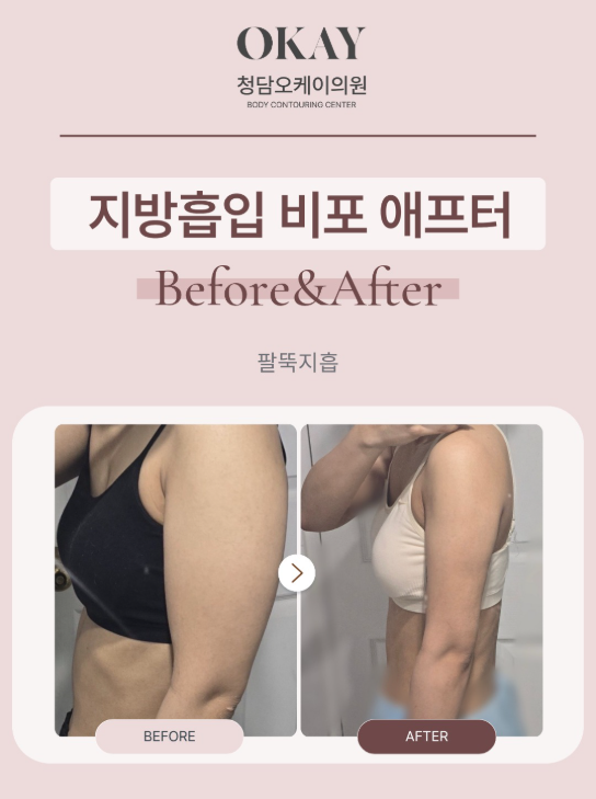 Gangnam Liposuction: Designing a Beautiful Silhouette Matters More Than Fat Removal image 10