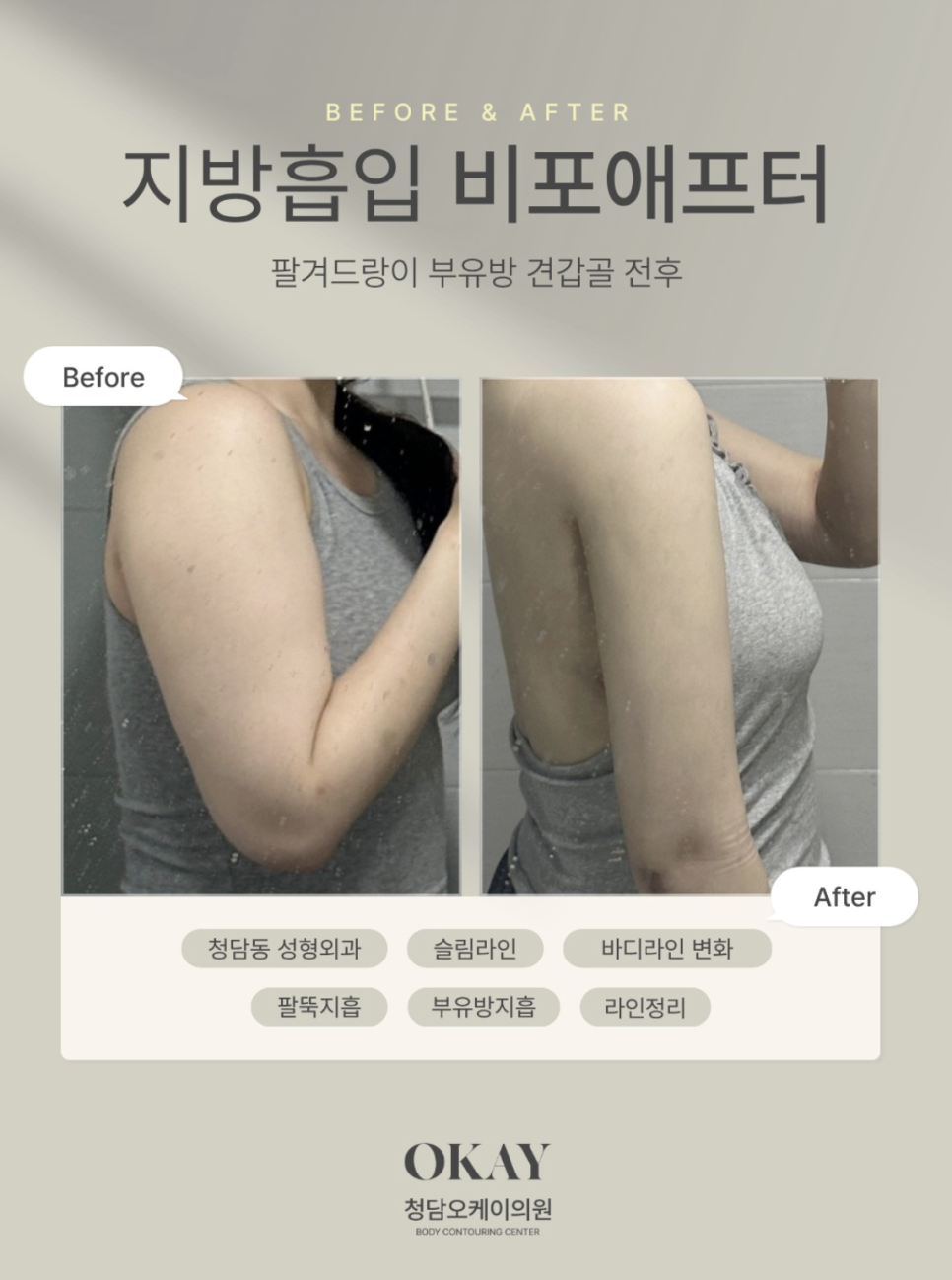 부유방지방흡입 효과 언제부터 보일까? 붓기·부작용·회복기간 총정리 관련 이미지 8