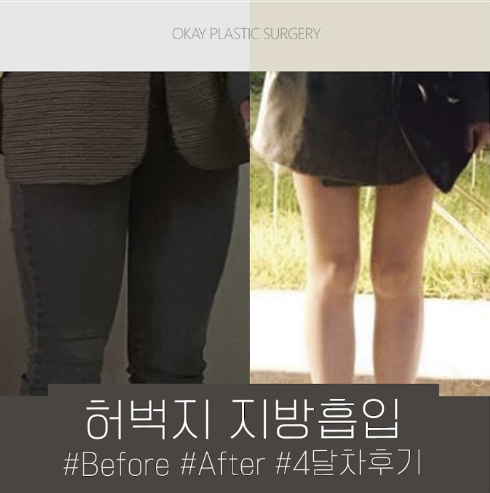 허엉무 지방흡입, 승마살부터 허벅지 안쪽까지 같이 봐야 하는 이유 관련 이미지 10