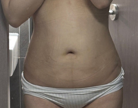 If you’re 고민ing about belly fat liposuction, which method is right for you in terms of price, side effects, and recovery period? image 8