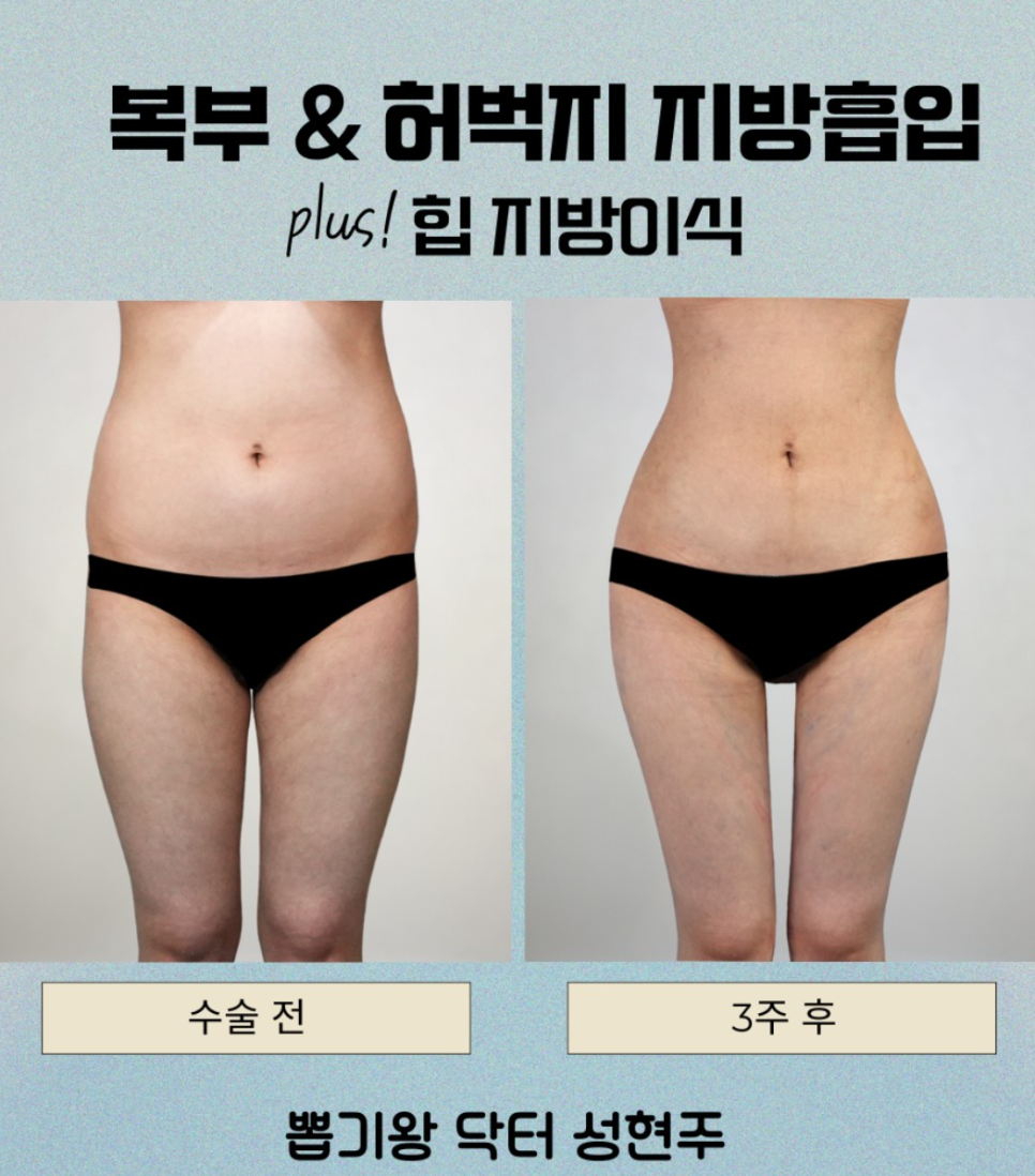 복부지방흡입 후기, 실제 허리라인은 어떻게 달라질까요? 관련 이미지 7