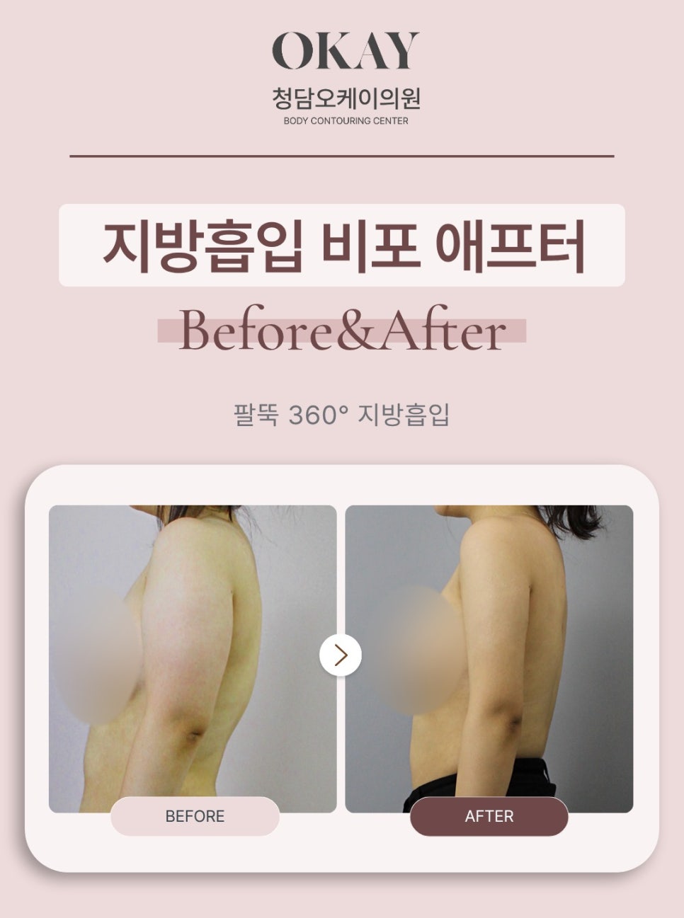 팔지방흡입, 많이 빼는 것보다 중요한 관련 이미지 8