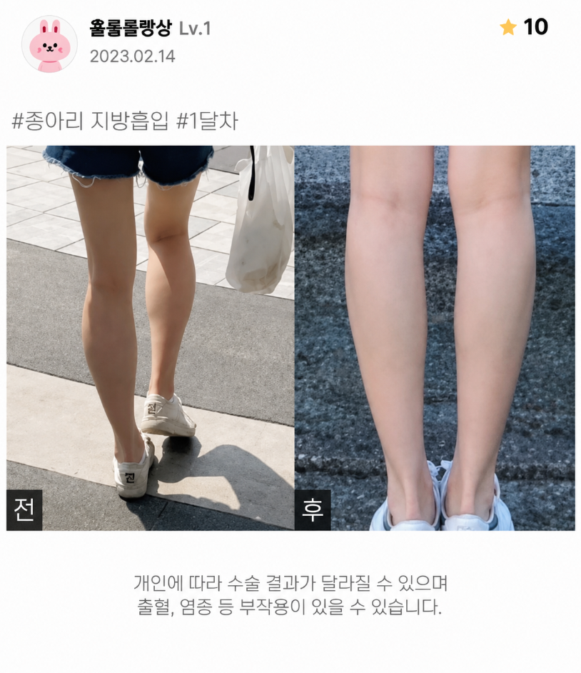 종아리지방흡입, 두꺼운 종아리 지방 때문인지 알 때문인지 구분해야 할까요? 관련 이미지 6