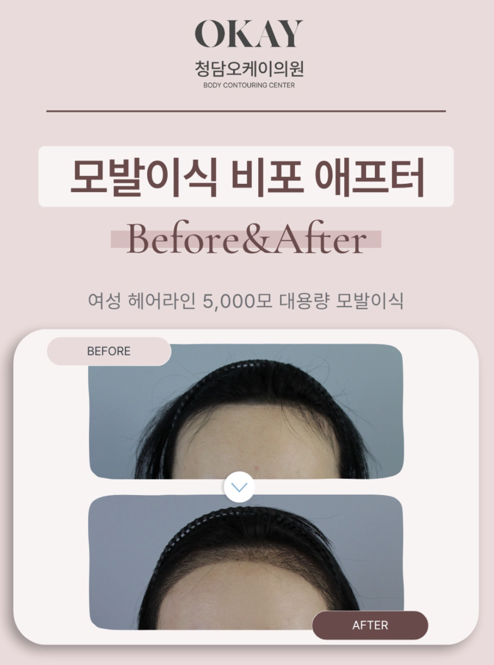 M-Shaped Hairline Hair Transplantation: Why Women Are Seeking It First image 2